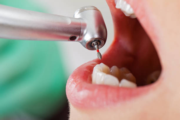 Best Emergency Dental Extractions in Homeland, CA